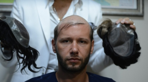 Protez saçta merdiven altı uygulamalara dikkat