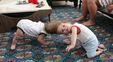 Kafadan yapışık siyam ikizleri 1 yaşında