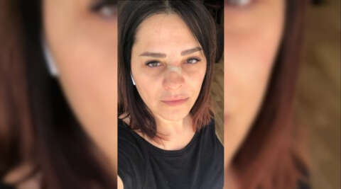 (Özel) Ünlü şarkıcı Reyhan Karaca’nın burnu kırıldı