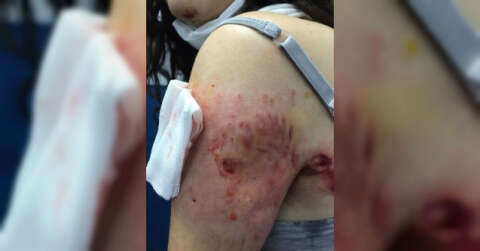 Sokak köpekleri genç kıza saldırdı