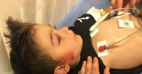 Köpeklerin saldırdığı 3 yaşındaki çocuğun yüzü parçalandı