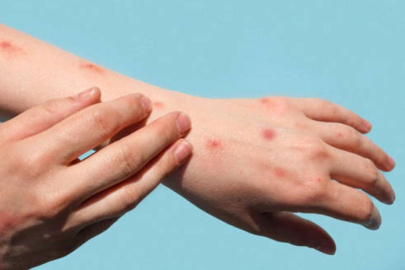 Sağlık Bakanlığı'ndan 81 ile 'kızamık' yazısı