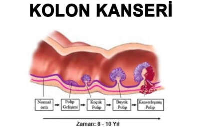 Hayat tarzınız kolon kanserine sebep olabilir