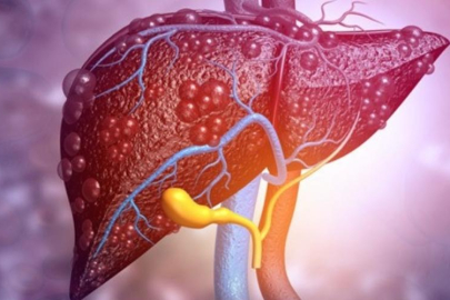 Karaciğer metastazında hastalar artık umutsuz değil