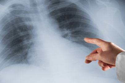 ‘‘Akciğer kanserinin Türkiye’deki ekonomik yükü 129 milyar TL’ye ulaştı’’