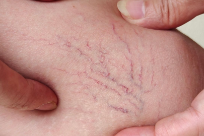 Uzmanından damar hastalıkları ile ilgili uyarılar