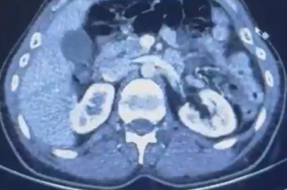 Ülkeye midelerinde uyuşturucu getiren şahıslar yakalandı