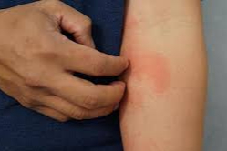 Türk Dermatoloji Derneği'nden ‘Uyuz' açıklaması