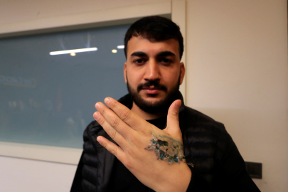 Dövme sildirmek isterken kabusu yaşadı