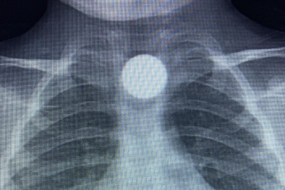 Bursa'da küçük çocuğun boğazına 50 kuruş kaçtı