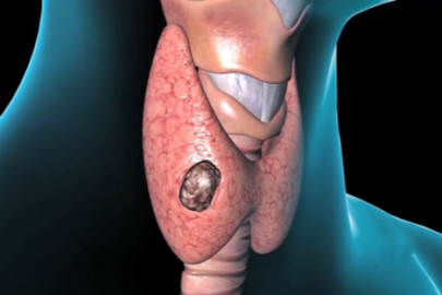 "Her tiroid kanseri ameliyat gerektirmez"