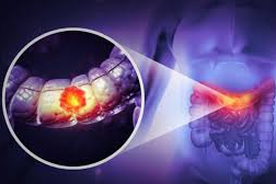 Kolon kanseri artık gençleri de tehdit ediyor