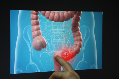 "Gençlerde rektum kanseri 4 kat fazla görülmeye başladı"