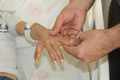 Yapışık parmaklı iki kardeş ameliyatla sağlıklarına kavuştu