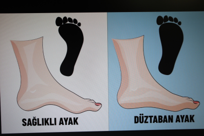 " Çocuklarda düztabanlık yüzde 90 oranında geçicidir"