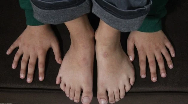 24 parmaklı çocuğun ayakkabı çilesi