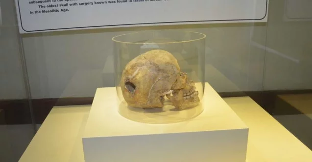 3 bin yıllık kafatasında ameliyat izi