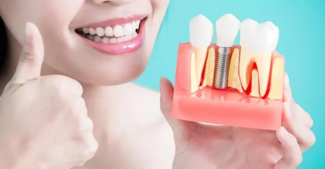 Kayıp dişleriniz için implant tedavisi tercih edin